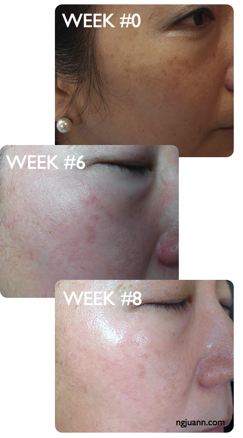 Obagi Toning Treat Melasma