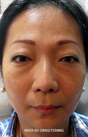 Obagi Pigmentation