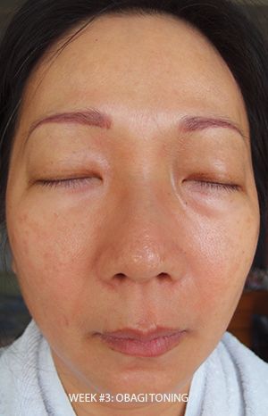 Obagi Pigmentation